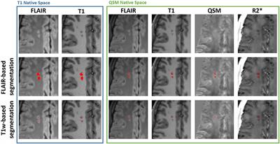 Quantitative susceptibility mapping (QSM) and R2* of silent cerebral infarcts in sickle cell anemia